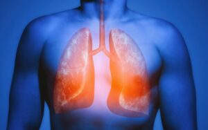 Representación de posibles daños pulmonares