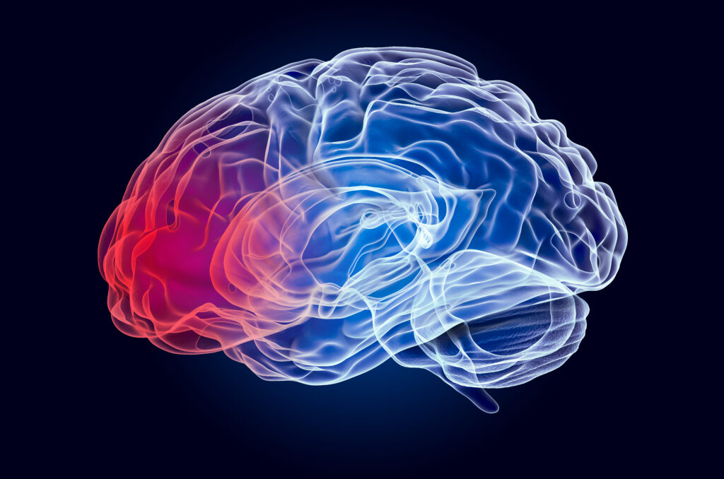 Una lesión cerebral traumática documentada mediante una marca roja en una parte del cerebro.