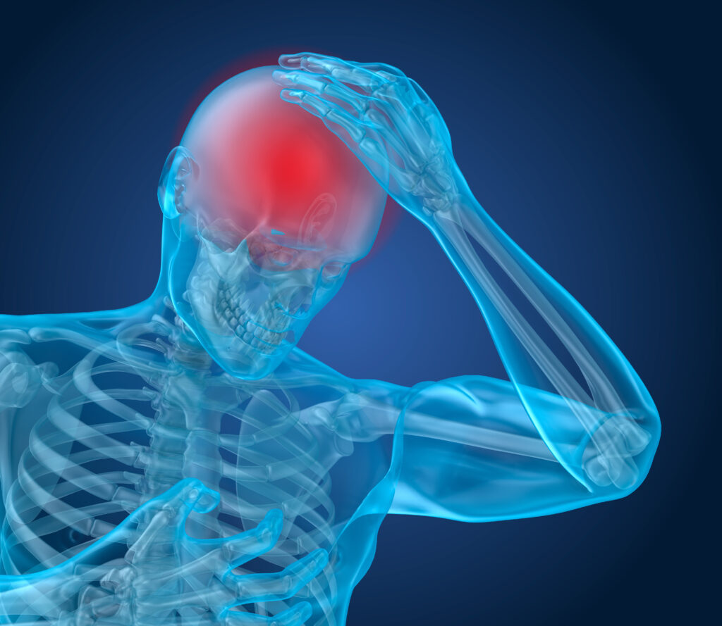 Diagrama de una persona que sufre una lesión cerebral: podría tratarse de una conmoción cerebral