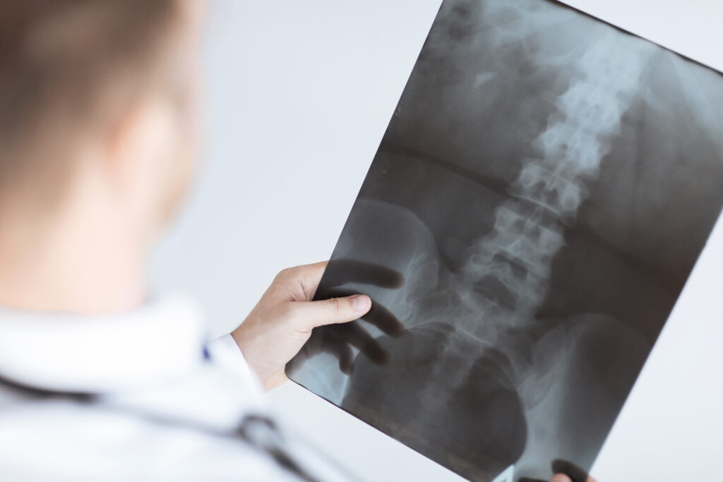 El médico examina las radiografías de las lesiones lumbares
