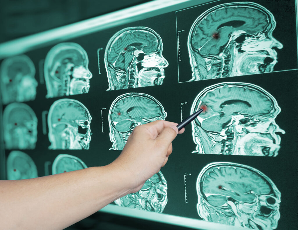 Un médico examina una lesión cerebral, posiblemente ETC