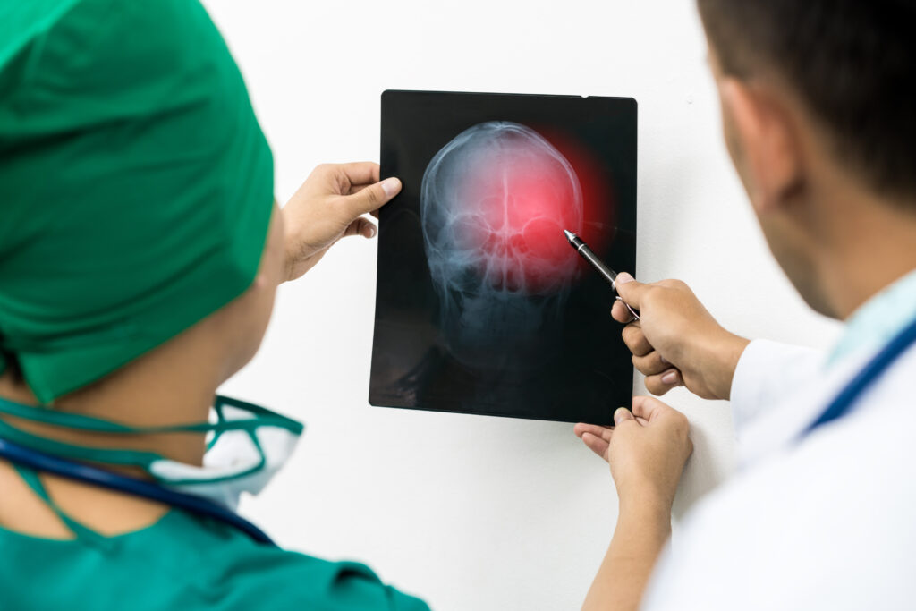 CTE: los médicos examinan las lesiones cerebrales