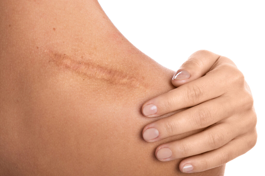 Cicatriz en el hombro: las cicatrices y la desfiguración pueden tener un efecto duradero.